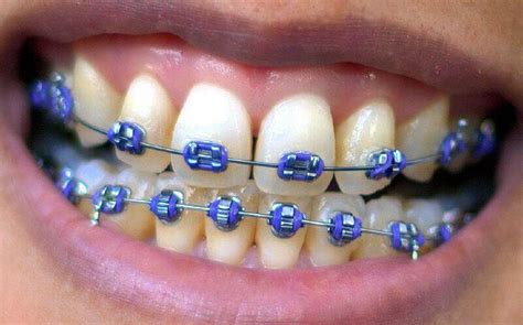are clares teeth fake